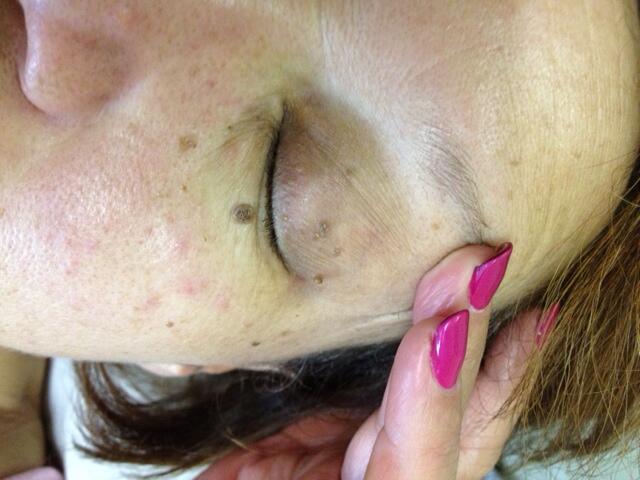 NACZYNKA/ WŁÓKNIAKI/ BRODAWKI/kaszaki/prosaki