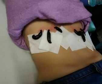 Pijawki lekarskie - Gabinet Hirudoterapii Lutomiersk