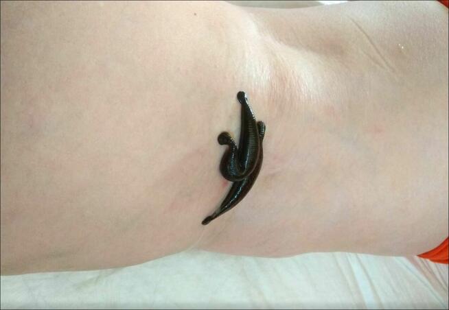 Pijawki lekarskie - Gabinet Hirudoterapii Lutomiersk