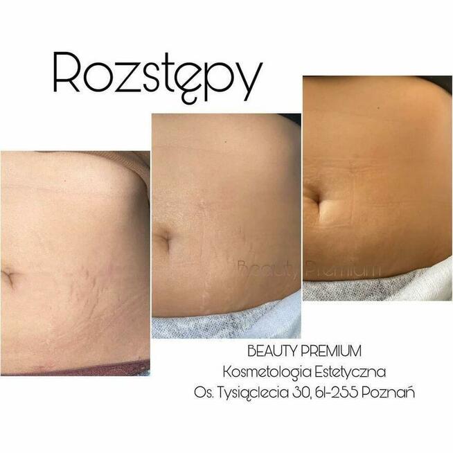 Egzosomy + radiofrekwencja mikroigłowa