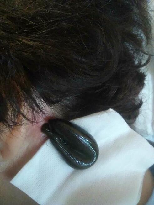 Pijawki lekarskie - Gabinet Hirudoterapii Lutomiersk