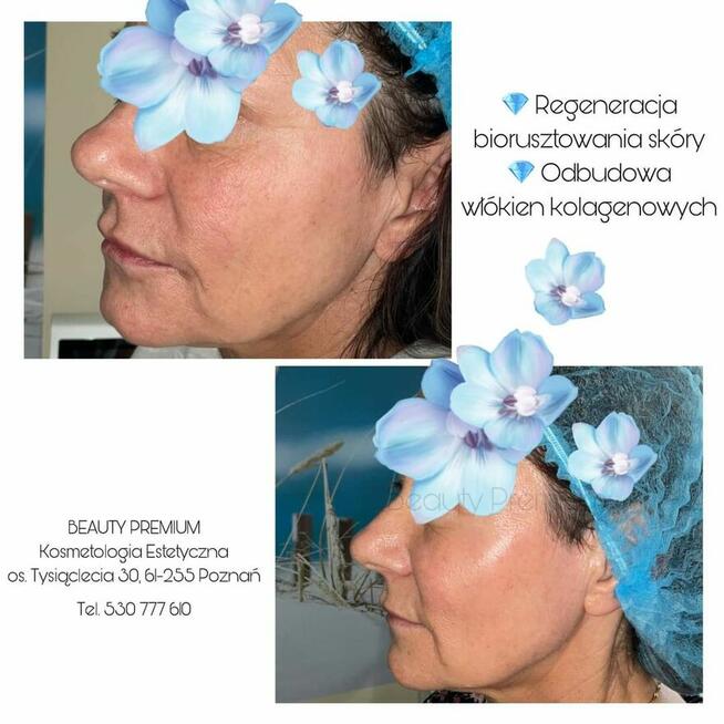 Egzosomy + radiofrekwencja mikroigłowa