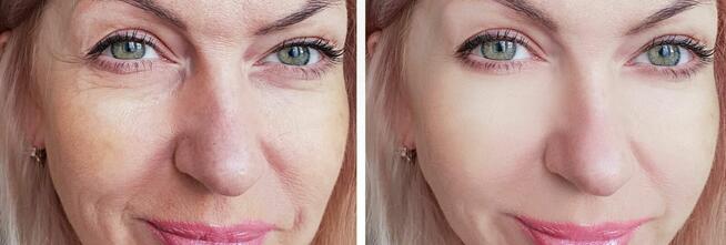 Venom krem dla pięknej skóry bez zmian na worki brodawki