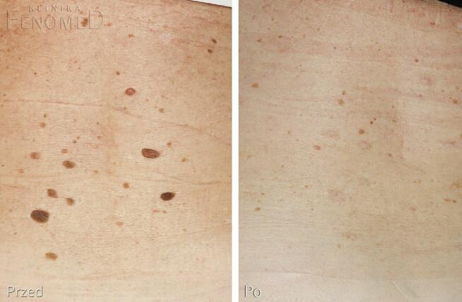 Venom krem dla pięknej skóry bez zmian na worki brodawki