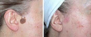 Venom krem dla pięknej skóry bez zmian na worki brodawki