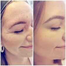 Venom krem dla pięknej skóry bez zmian na worki brodawki