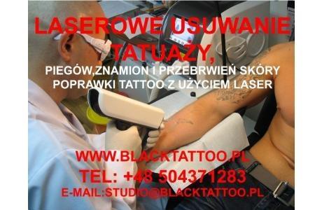 Laserowe usuwanie tatuaży piegów znamion itp