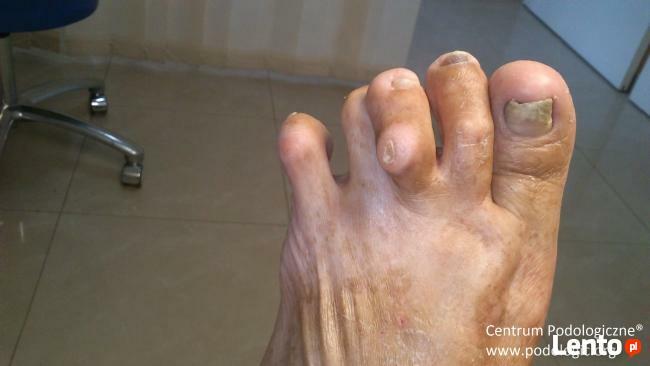 Usuwanie odcisków, korekta wrastających paznokci