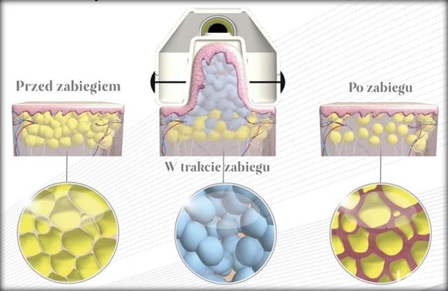 Kriolipoliza ,cool tech , trwałe odchudzanie