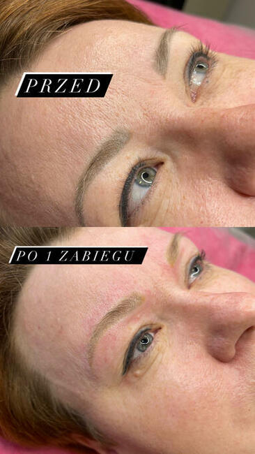 Laserowe usuwanie tatuaży oraz makijażu permanentnego