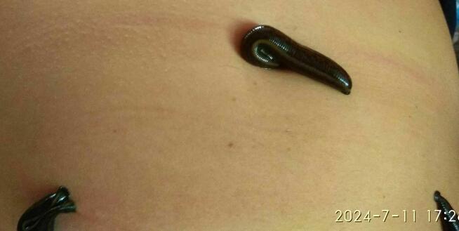 Pijawki lekarskie - Gabinet Hirudoterapii Lutomiersk