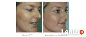 LAMPA LED PDT ŚWIATŁO-KOLORO-TERAPIA - NANO BIOMED I