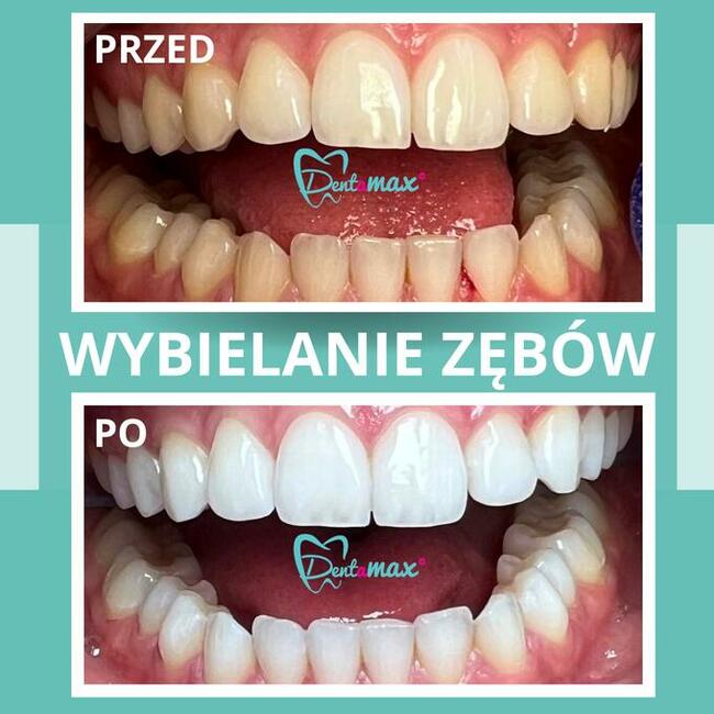 Skuteczne wybielanie zębów Kraków - Dentamax Nowosądecka 46