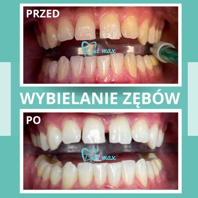 Skuteczne wybielanie zębów Kraków - Dentamax Nowosądecka 46