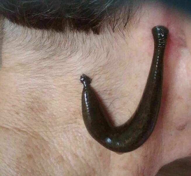 Pijawki lekarskie - Gabinet Hirudoterapii Lutomiersk