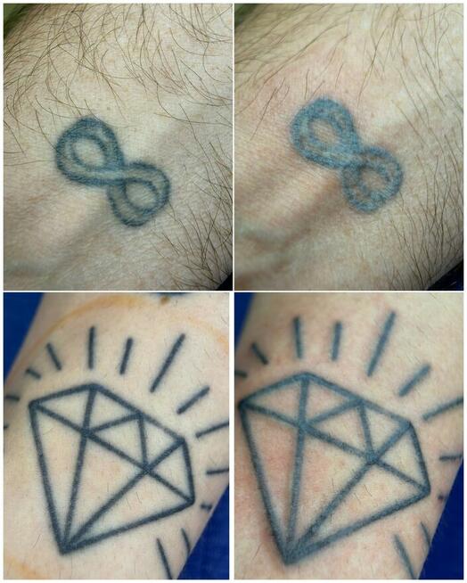 Usuwanie tatuaży removerem