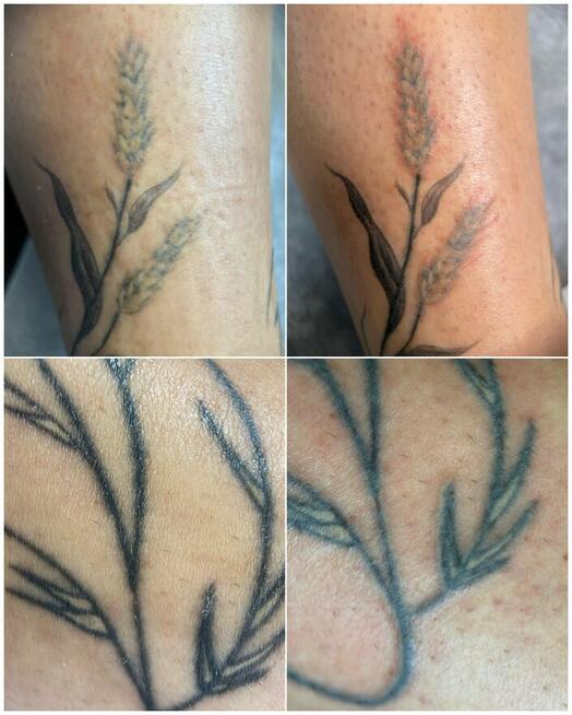 Usuwanie tatuaży removerem