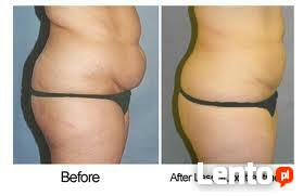 Kriolipoliza -chłodzenie tkanki tłuszczowej