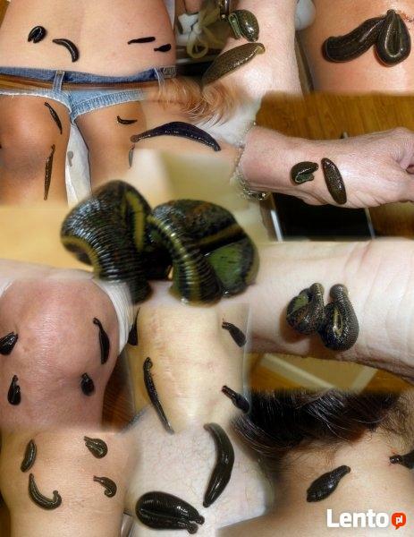Pijawki Ślask Hirudoterapia Gabinet Naturoterapii
