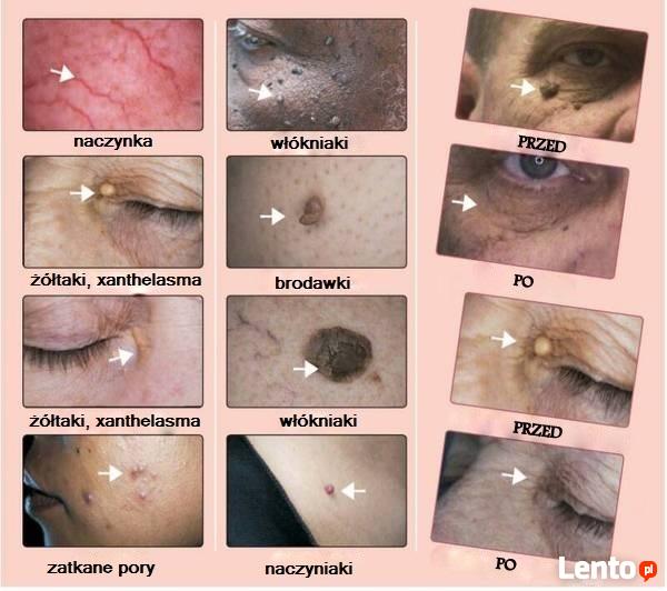 Zamykanie naczynek/ usuwanie włókniaków/brodawek/kaszaki