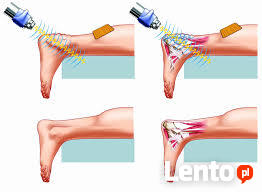 Terapia Falą Uderzeniową Gabinet fizykoterapii Masaż Trakcja