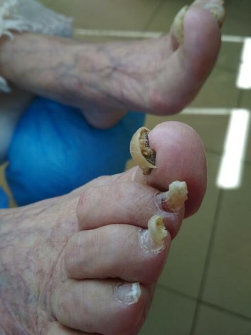 Wrastające paznokcie , odciski, pękające pięty, Podologia