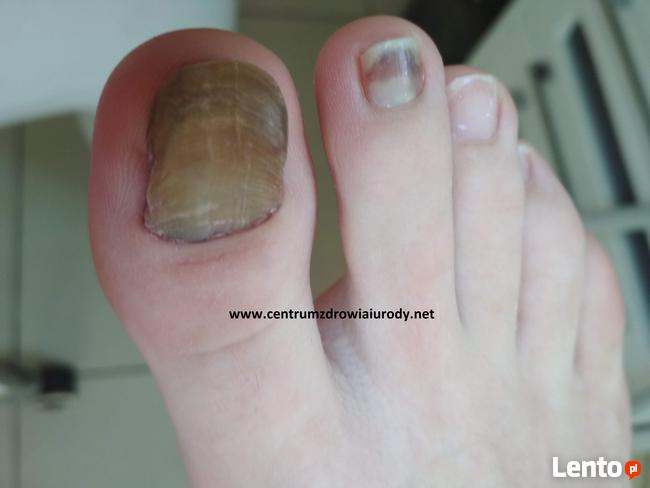 Wrastające paznokcie , odciski, pękające pięty, Podologia