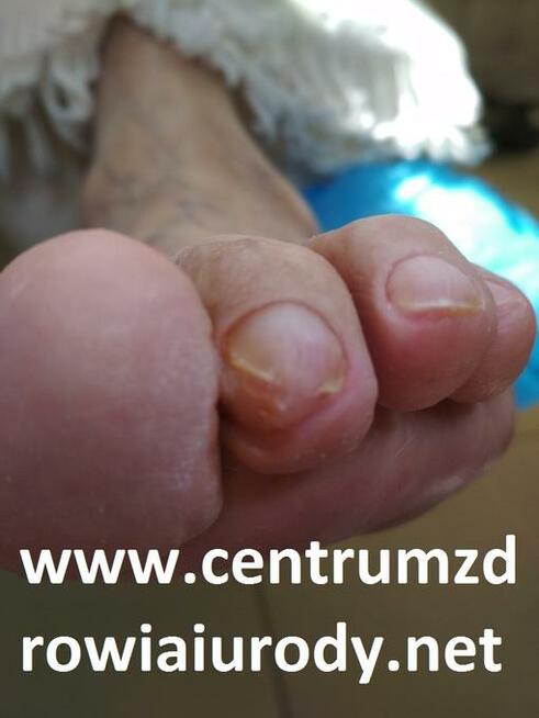 Wrastające paznokcie , odciski, pękające pięty, Podologia