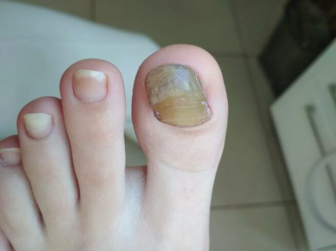 Wrastające paznokcie , odciski, pękające pięty, Podologia