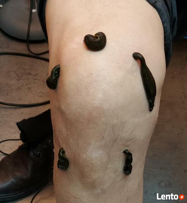 Hirudoterapia - leczenie pijawkami lekarskimi.