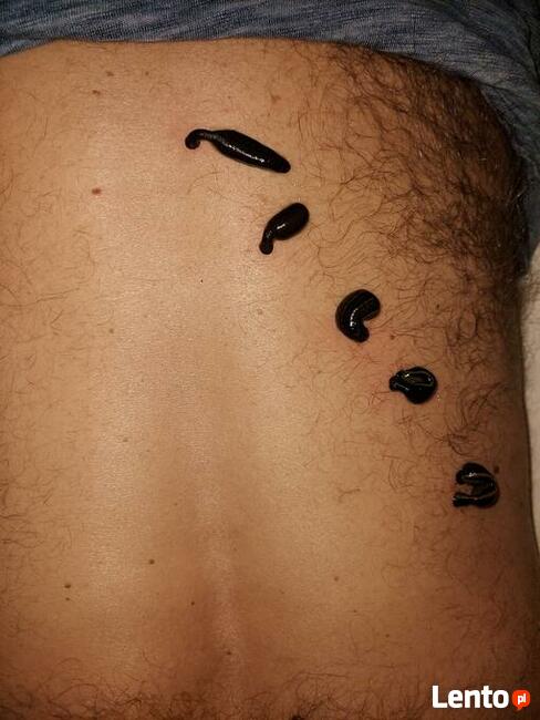 Hirudoterapia - leczenie pijawkami lekarskimi.