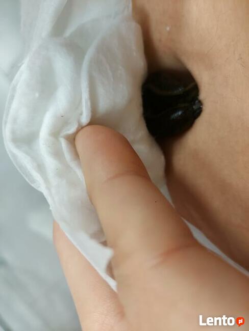 Hirudoterapia - leczenie pijawkami lekarskimi.