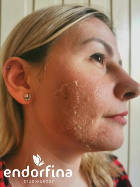 Promocja na zabiegi kosmetyczne na twarz i kwasy -10%