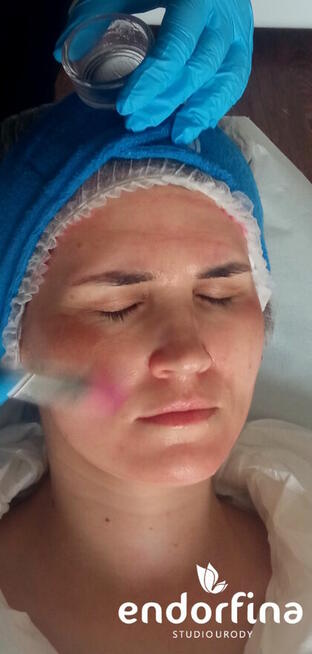 Promocja na zabiegi kosmetyczne na twarz i kwasy -10%