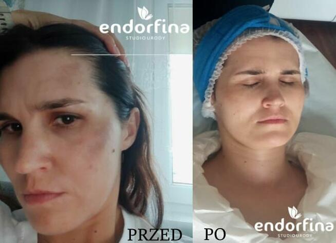 Promocja na zabiegi kosmetyczne na twarz i kwasy -10%