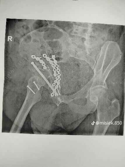 Proszę o pomoc w rehabilitacji