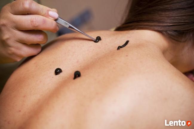 Leczenie Pijawkami Lekarskimi Bytom