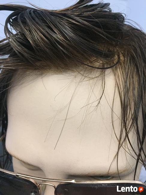 Niechirurgiczny przeszczep włosów, uzupełnianie ubytków