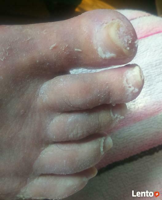 Dla seniorów, diabetyków - pedicure leczniczy