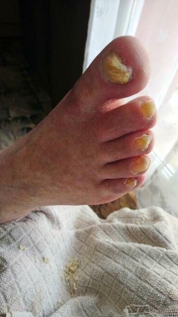Dla seniorów, diabetyków - pedicure leczniczy
