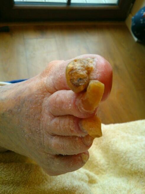 Dla seniorów, diabetyków - pedicure leczniczy