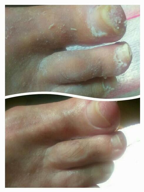 Dla seniorów, diabetyków - pedicure leczniczy