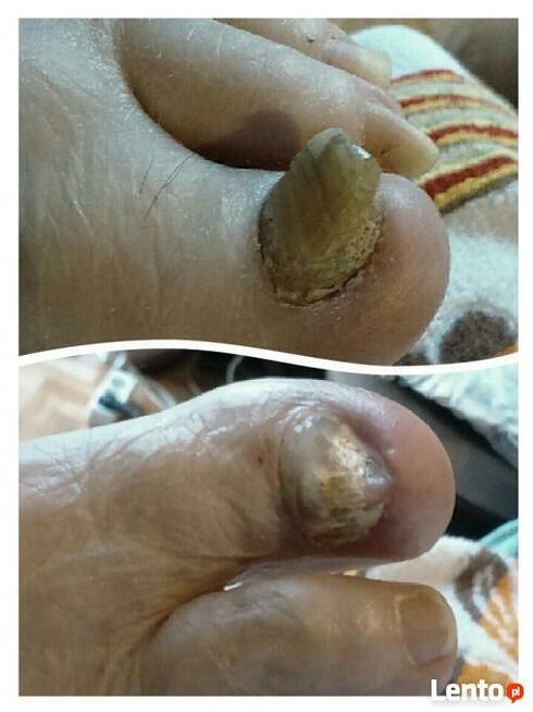 Dla seniorów, diabetyków - pedicure leczniczy