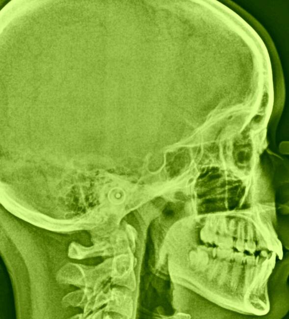 zdjęcie RTG Cefalometryczne