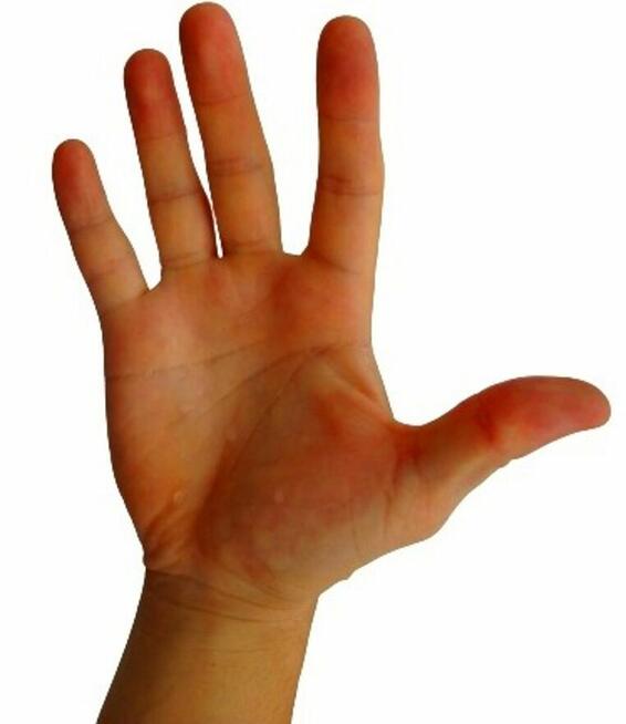 Jonoforeza przeciw nadmiernemu poceniu sie dłonie stopy ręce