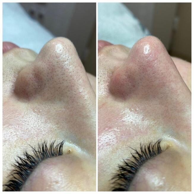 Oczyszczanie wodorowe twarzy - promocja