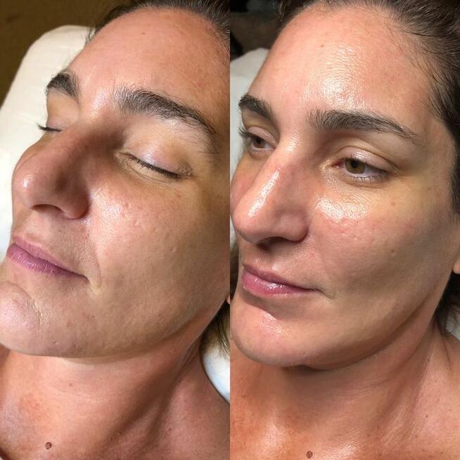 Oczyszczanie wodorowe twarzy - promocja