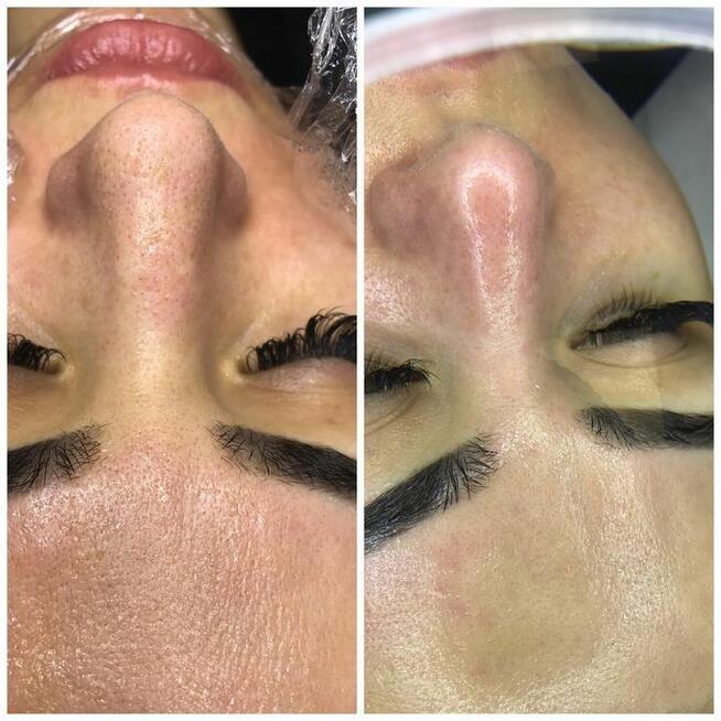 Oczyszczanie wodorowe twarzy - promocja