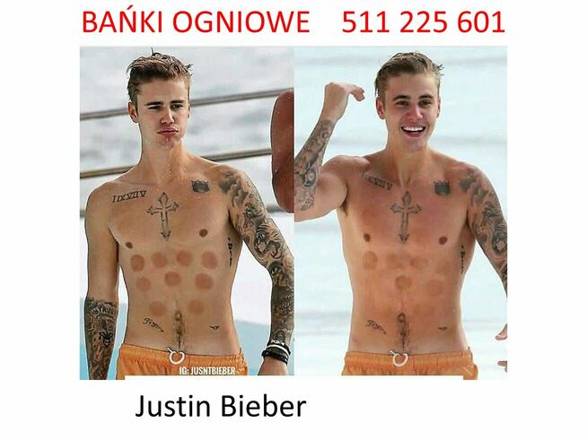 Bańki OGNIOWE w domu klienta - POBUDZENIE ODPORNOŚCI