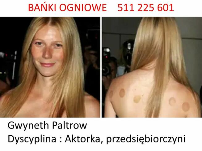 Bańki OGNIOWE w domu klienta - POBUDZENIE ODPORNOŚCI